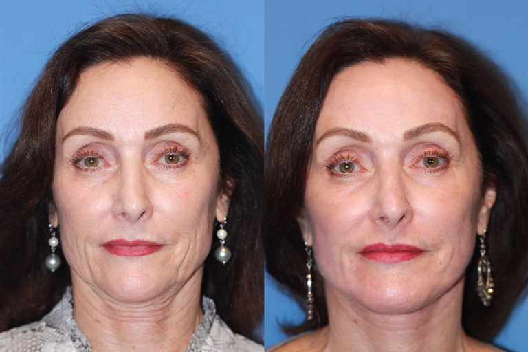 Αποτελέσματα που Σοκάρουν – Δείτε & Νιώστε τη Διαφορά στο Πρόσωπο