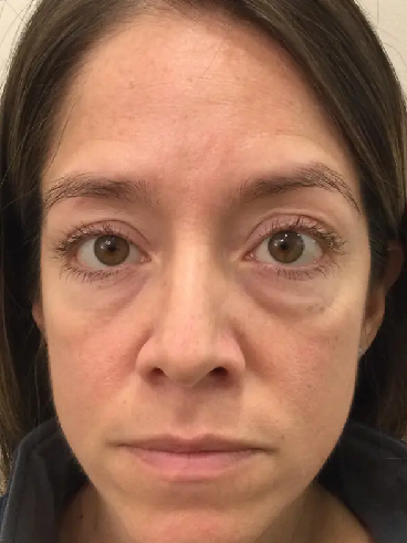 Before image for Νεφέλη Μ.