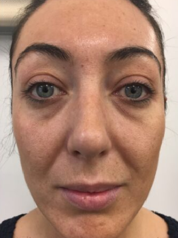 Before image for Μαρίνα Π.