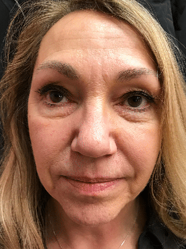 Before image for Ελένη Α.