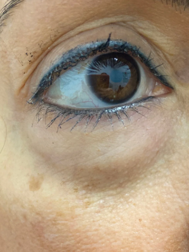 Before image for Κατερίνα Γ.