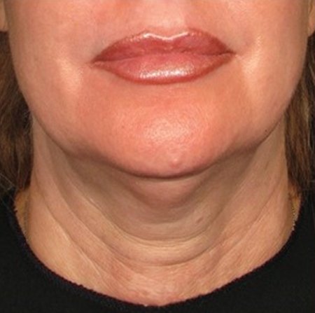 Before image for Αγγελική Κ.