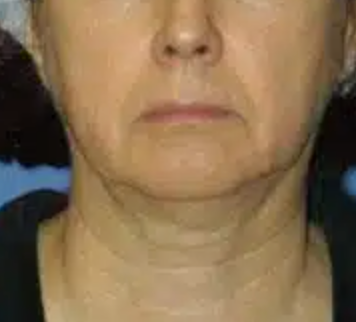 Before image for Όλγα Κ.