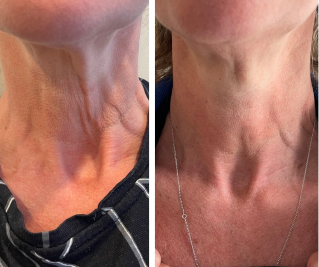 Αποτελέσματα που Σοκάρουν – Δείτε & Νιώστε τη Διαφορά Στον Λαιμό