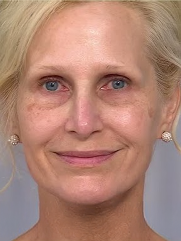 Before image for Λίνα Μ.