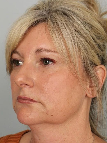 Before image for Αναστασία Κ.