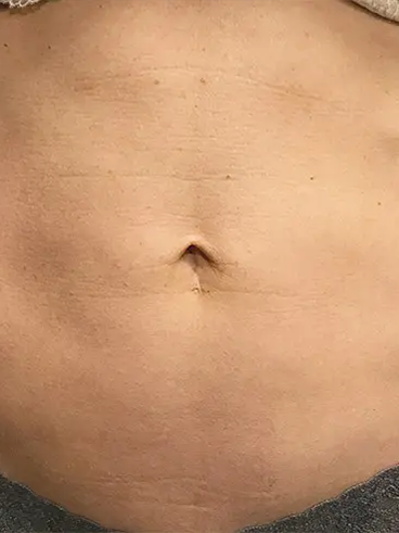 Before image for Σοφία Κ.