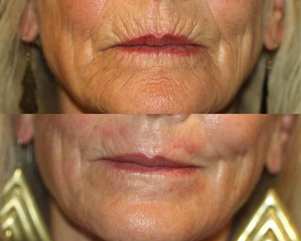 Αποτελέσματα που Σοκάρουν – Δείτε & Νιώστε τη Διαφορά γύρω από το Στόμα