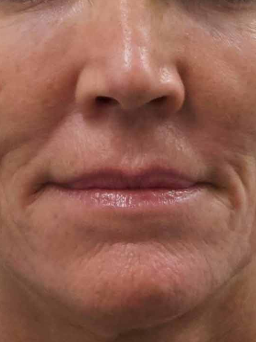 Before image for Ειρήνη Κ.