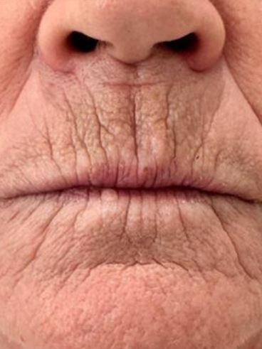 Before image for Τζένη Β.