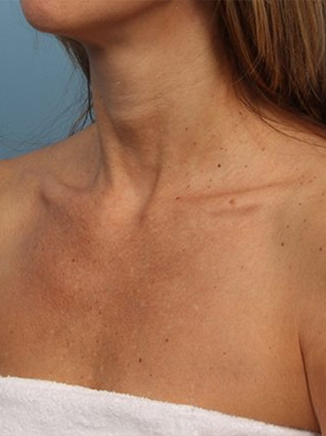 Before image for Δανάη Π.