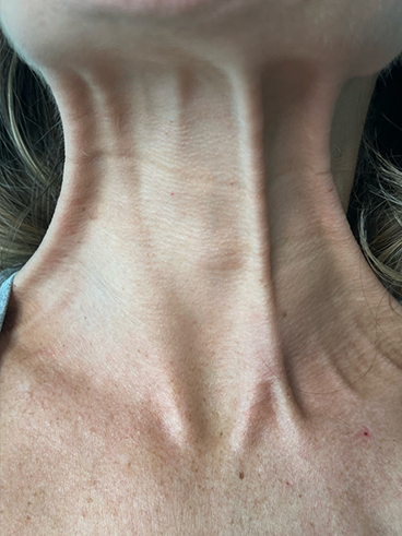 Before image for Τζένη Β.