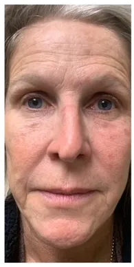 Before image for Τόνια Β.