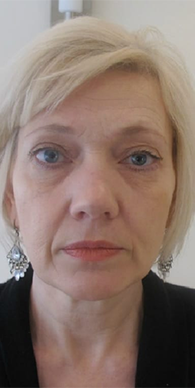 Before image for Κατερίνα Μ.