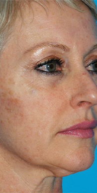 Before image for Ελένη Κ.