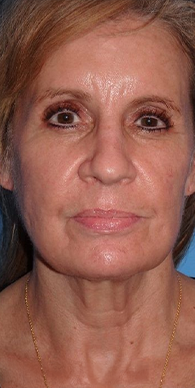 Before image for Γιάννα Α.