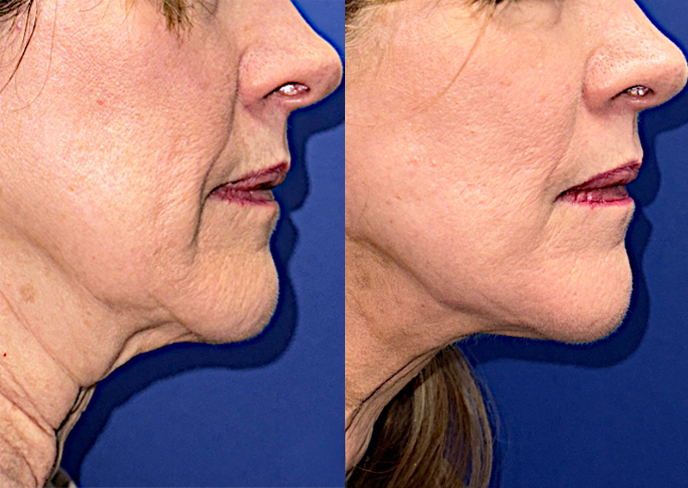 Αποτελέσματα που Σοκάρουν — Δείτε & Νιώστε τη Διαφορά στο Λαιμό & Ντεκολτέ