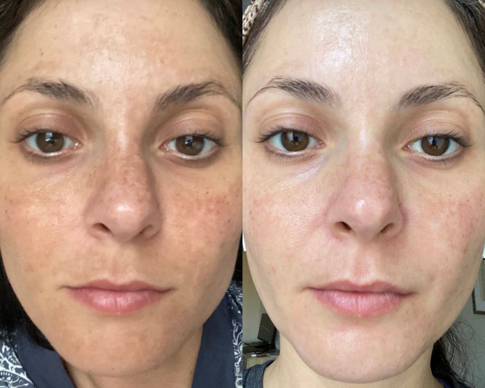 Αποτελέσματα που Εντυπωσιάζουν — Νιώστε τη Διαφορά στην Επιδερμίδα σας.